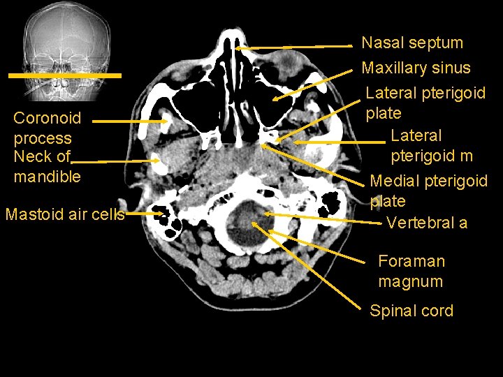 Coronoid process Neck of mandible Mastoid air cells Nasal septum Maxillary sinus Lateral pterigoid