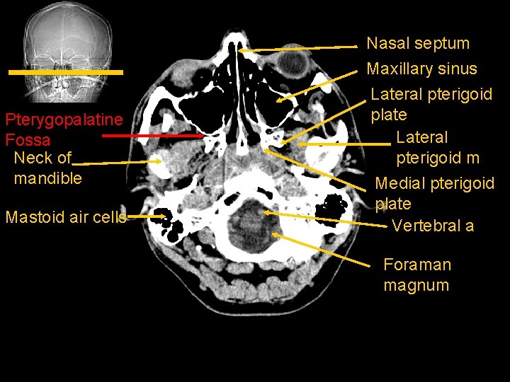 Pterygopalatine Fossa Neck of mandible Mastoid air cells Nasal septum Maxillary sinus Lateral pterigoid