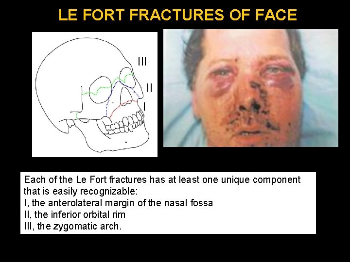 LE FORT FRACTURES OF FACE III II I Each of the Le Fort fractures