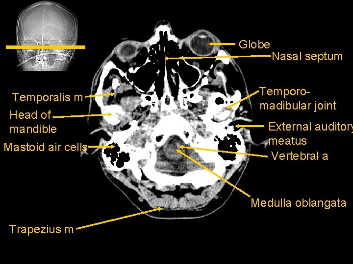 Globe Temporalis m Head of mandible Mastoid air cells Nasal septum Temporomadibular joint External