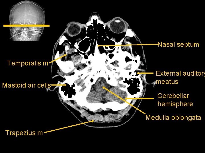 Nasal septum Temporalis m Mastoid air cells External auditory meatus Cerebellar hemisphere Medulla oblongata