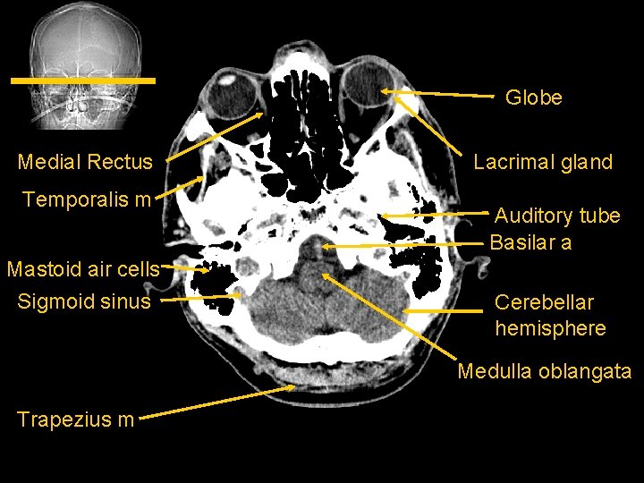 Globe Medial Rectus Temporalis m Mastoid air cells Sigmoid sinus Lacrimal gland Auditory tube