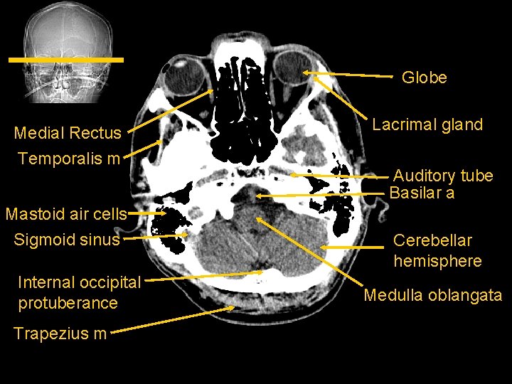 Globe Medial Rectus Temporalis m Mastoid air cells Sigmoid sinus Internal occipital protuberance Trapezius