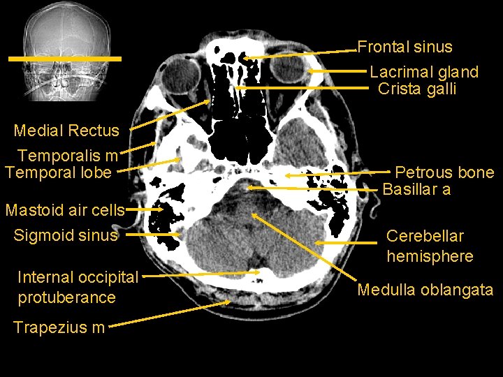 Frontal sinus Lacrimal gland Crista galli Medial Rectus Temporalis m Temporal lobe Mastoid air