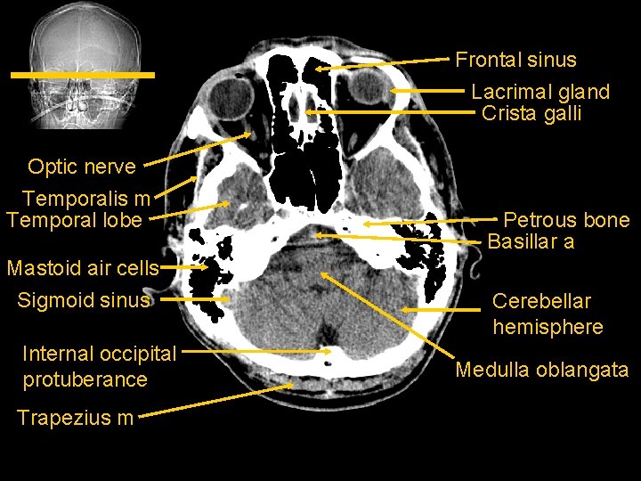 Frontal sinus Lacrimal gland Crista galli Optic nerve Temporalis m Temporal lobe Mastoid air