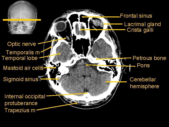 Frontal sinus Lacrimal gland Crista galli Optic nerve Temporalis m Temporal lobe Mastoid air