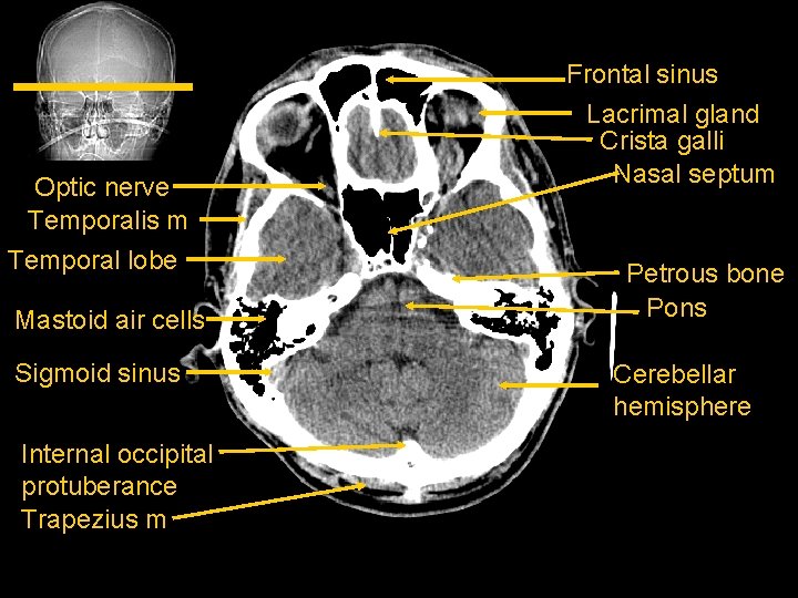 Optic nerve Temporalis m Temporal lobe Mastoid air cells Sigmoid sinus Internal occipital protuberance