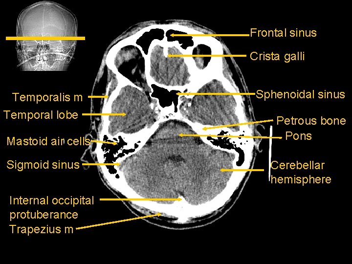 Frontal sinus Crista galli Temporalis m Temporal lobe Mastoid air cells Sigmoid sinus Internal