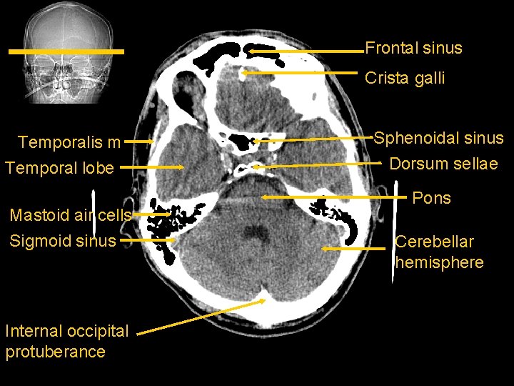Frontal sinus Crista galli Temporalis m Temporal lobe Mastoid air cells Sigmoid sinus Internal