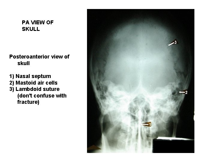 PA VIEW OF SKULL Posteroanterior view of skull 1) Nasal septum 2) Mastoid air