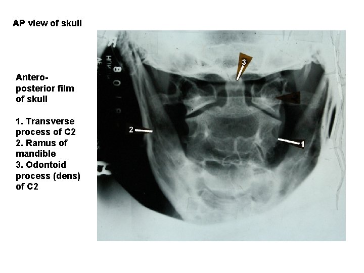 AP view of skull Anteroposterior film of skull 1. Transverse process of C 2