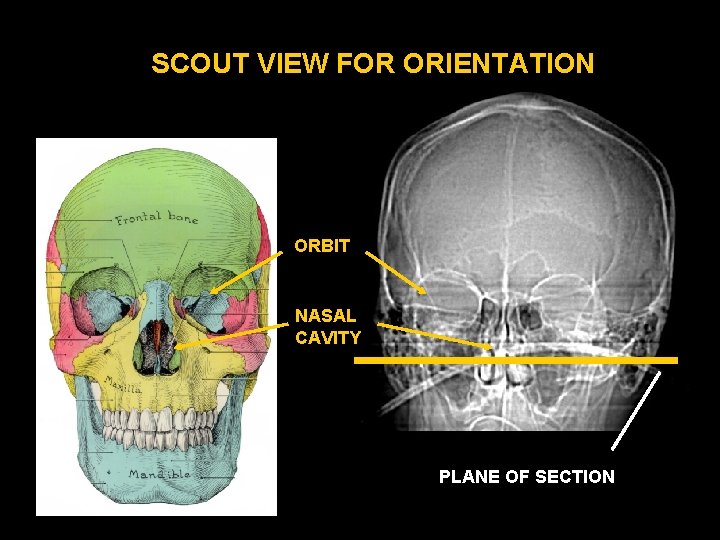 SCOUT VIEW FOR ORIENTATION ORBIT NASAL CAVITY PLANE OF SECTION 