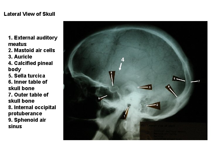 Lateral View of Skull 1. External auditory meatus 2. Mastoid air cells 3. Auricle