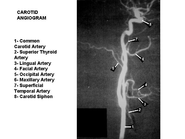 CAROTID ANGIOGRAM 1 - Common Carotid Artery 2 - Superior Thyroid Artery 3 -