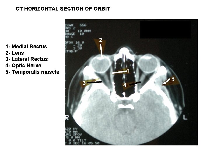 CT HORIZONTAL SECTION OF ORBIT 1 - Medial Rectus 2 - Lens 3 -