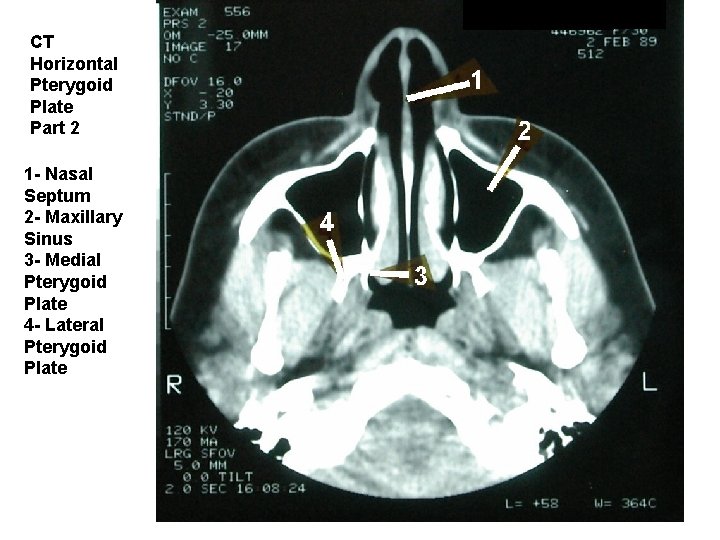 CT Horizontal Pterygoid Plate Part 2 1 - Nasal Septum 2 - Maxillary Sinus