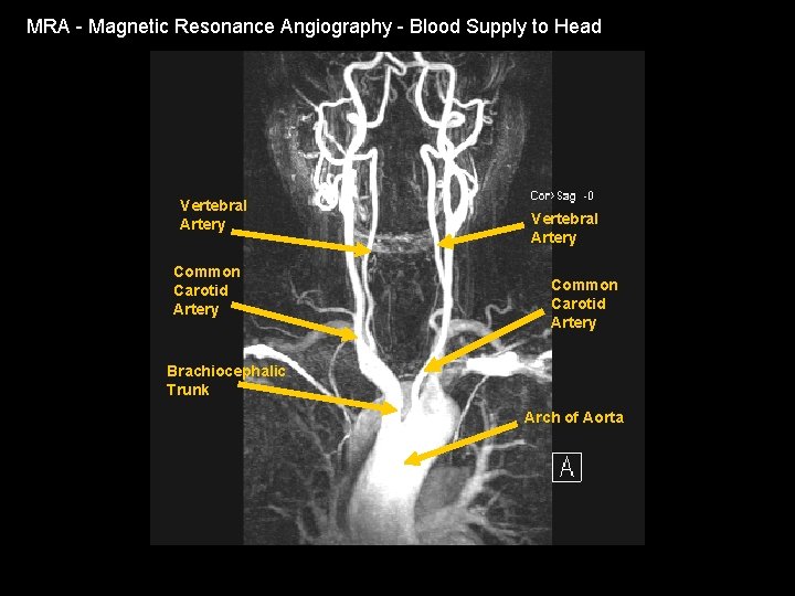 MRA - Magnetic Resonance Angiography - Blood Supply to Head Vertebral Artery Common Carotid