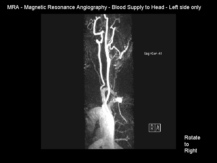 MRA - Magnetic Resonance Angiography - Blood Supply to Head - Left side only