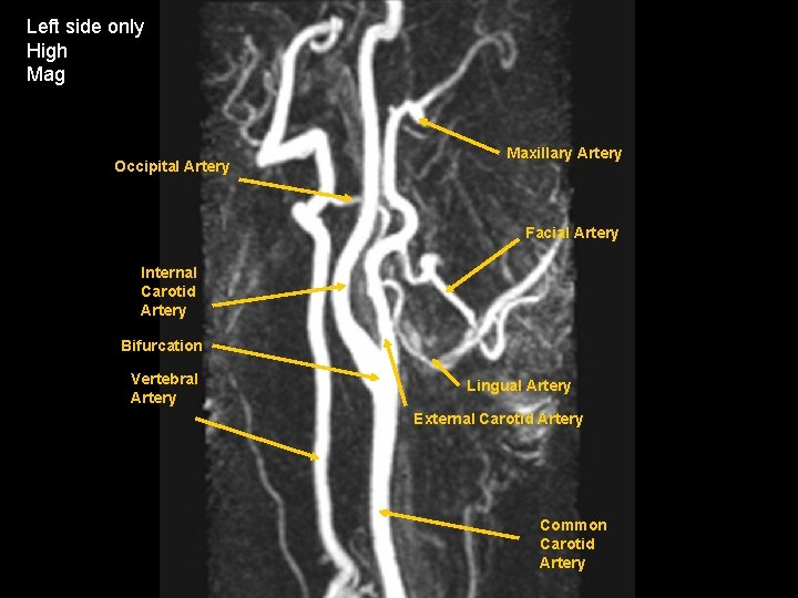 Left side only High Mag Occipital Artery Maxillary Artery Facial Artery Internal Carotid Artery