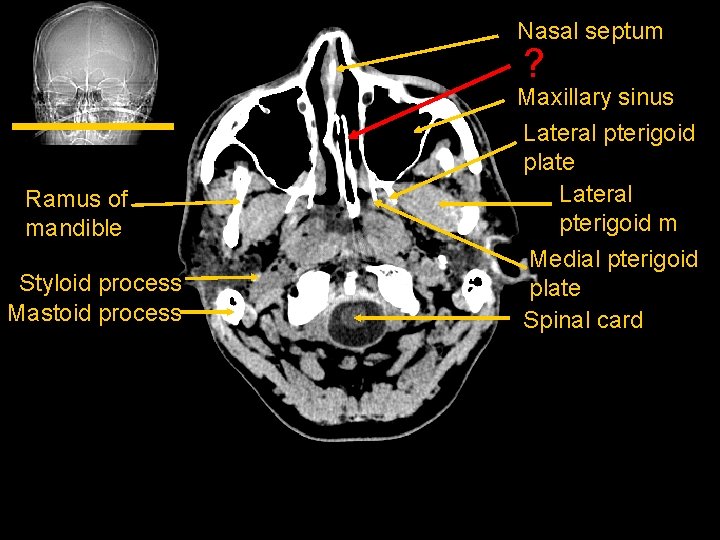 Nasal septum ? Ramus of mandible Styloid process Mastoid process Maxillary sinus Lateral pterigoid
