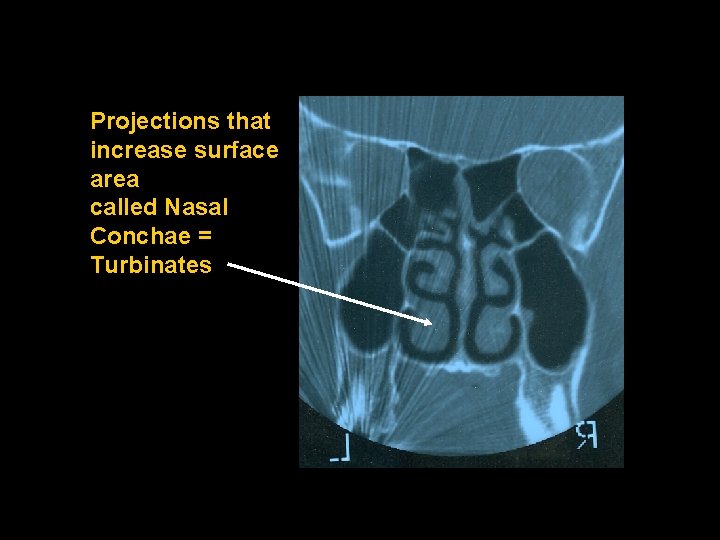 Projections that increase surface area called Nasal Conchae = Turbinates 