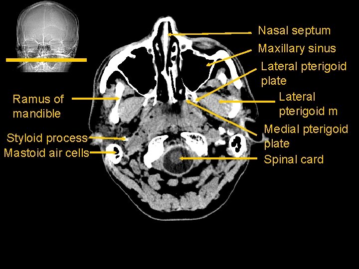 Ramus of mandible Styloid process Mastoid air cells Nasal septum Maxillary sinus Lateral pterigoid