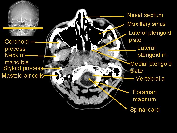 Coronoid process Neck of mandible Styloid process Mastoid air cells Nasal septum Maxillary sinus