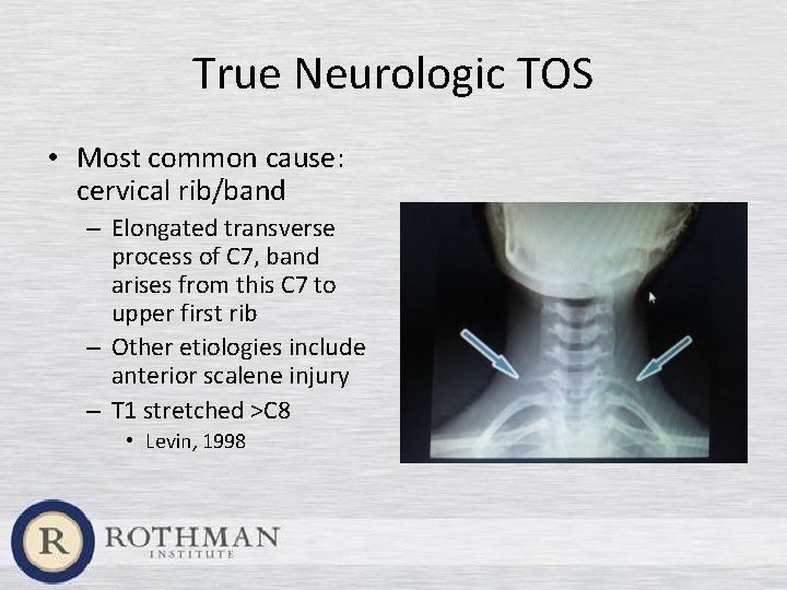 True Neurologic TOS • Most common cause: cervical rib/band – Elongated transverse process of