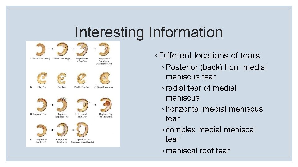 Interesting Information ◦ Different locations of tears: ◦ Posterior (back) horn medial meniscus tear