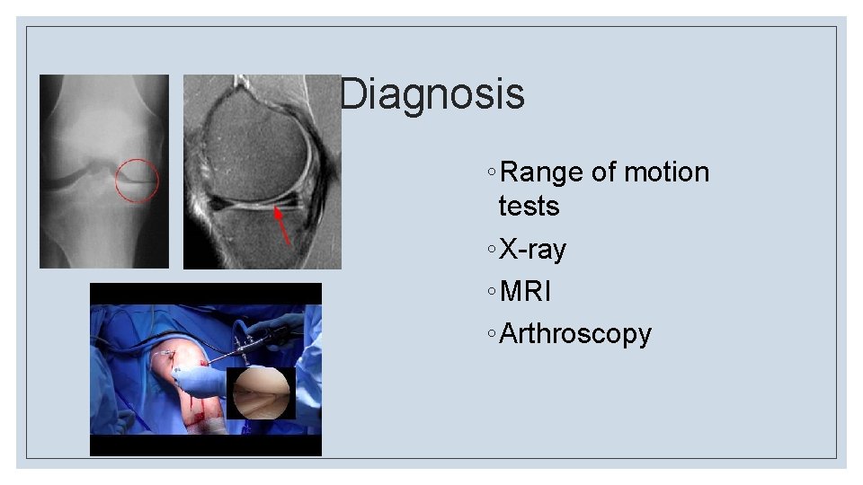 Diagnosis ◦ Range of motion tests ◦ X-ray ◦ MRI ◦ Arthroscopy 