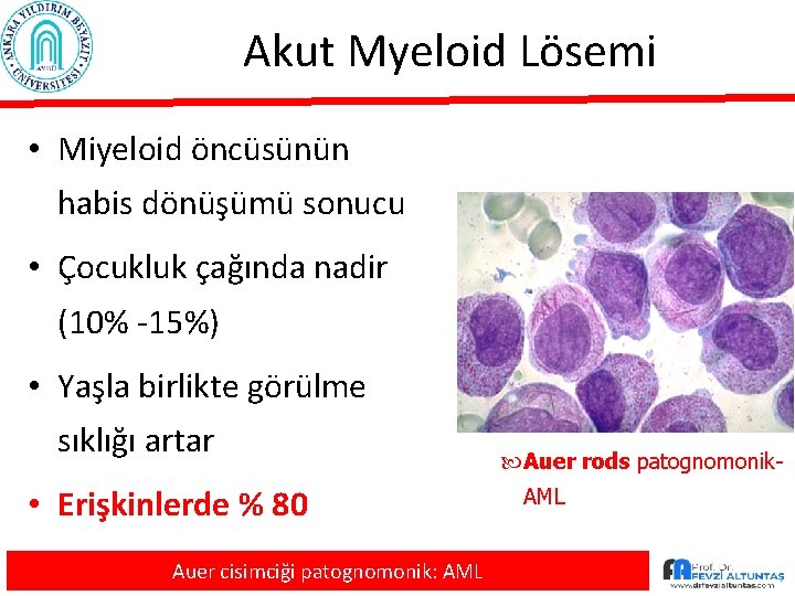 Akut Myeloid Lösemi • Miyeloid öncüsünün habis dönüşümü sonucu • Çocukluk çağında nadir (10%