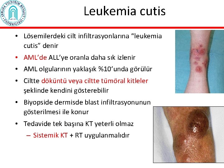 Leukemia cutis • Lösemilerdeki cilt infiltrasyonlarına “leukemia cutis” denir • AML’de ALL’ye oranla daha