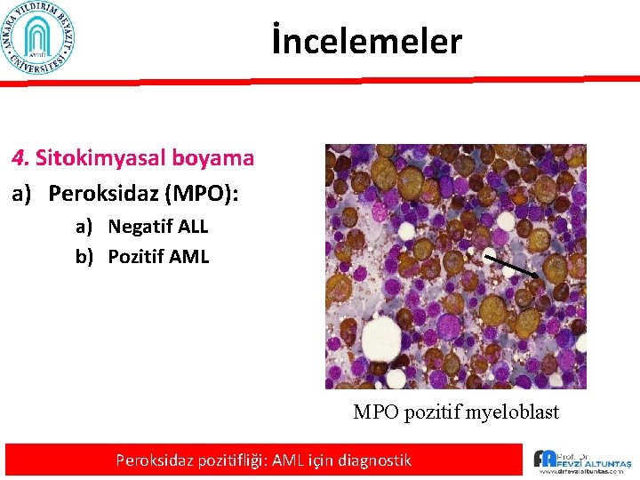 İncelemeler 4. Sitokimyasal boyama a) Peroksidaz (MPO): a) Negatif ALL b) Pozitif AML MPO