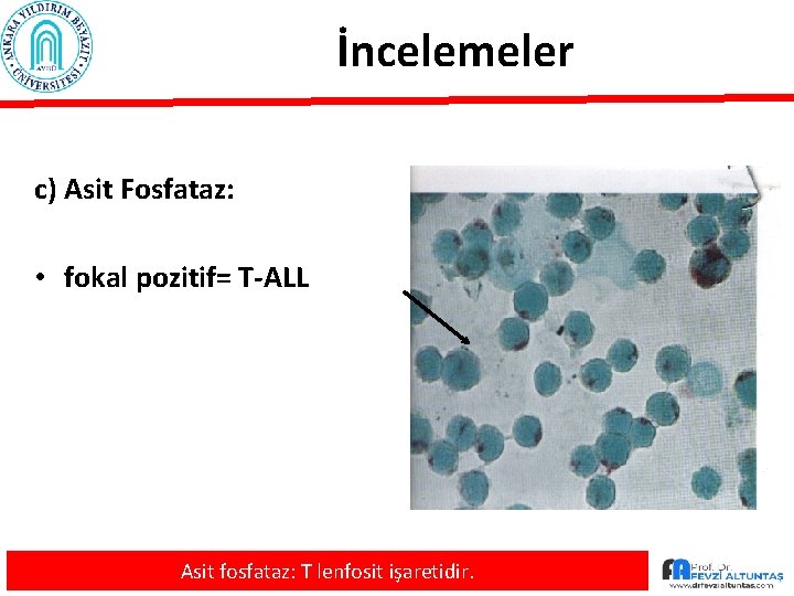 İncelemeler c) Asit Fosfataz: • fokal pozitif= T-ALL Asit fosfataz: T lenfosit işaretidir. 