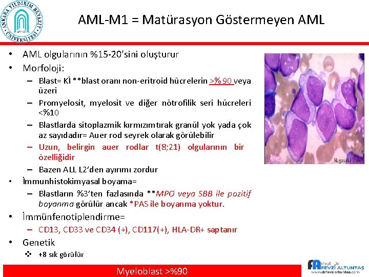 AML-M 1 = Matürasyon Göstermeyen AML • AML olgularının %15 -20’sini oluşturur • Morfoloji: