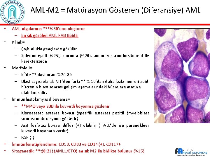 AML-M 2 = Matürasyon Gösteren (Diferansiye) AML • • • AML olgularının ***%30’unu oluşturur