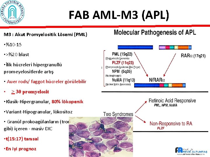 FAB AML-M 3 (APL) M 3 : Akut Promyelositik Lösemi (PML) • %10 -15