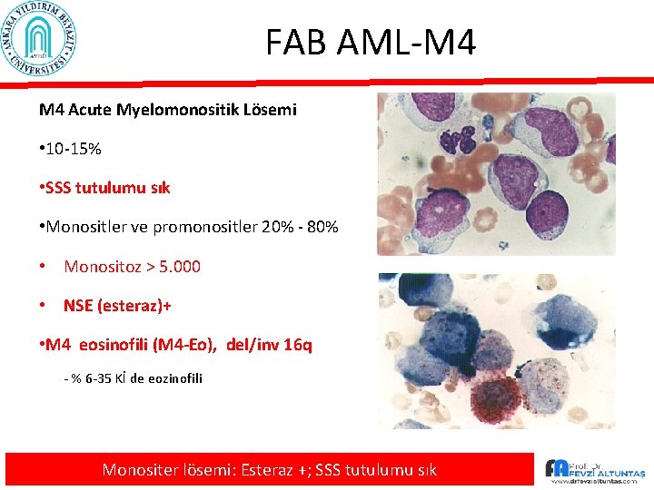 FAB AML-M 4 Acute Myelomonositik Lösemi • 10 -15% • SSS tutulumu sık •