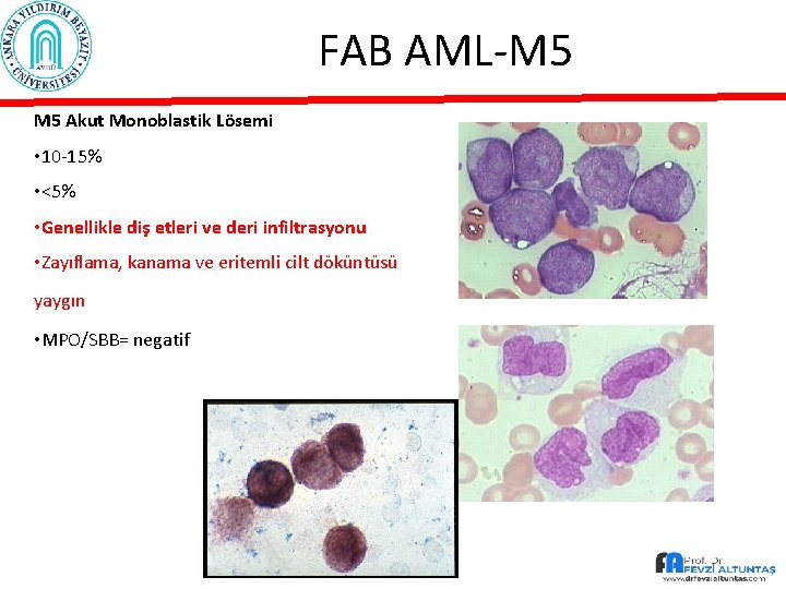 FAB AML-M 5 Akut Monoblastik Lösemi • 10 -15% • <5% • Genellikle diş