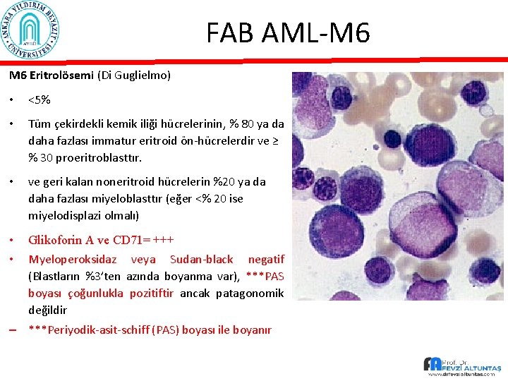 FAB AML-M 6 Eritrolösemi (Di Guglielmo) • <5% • Tüm çekirdekli kemik iliği hücrelerinin,