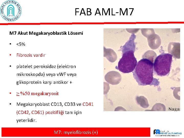 FAB AML-M 7 Akut Megakaryoblastik Lösemi • <5% • Fibrozis vardır • platelet peroksidaz