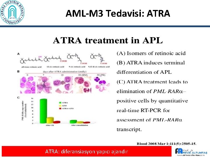 AML-M 3 Tedavisi: ATRA: diferansiasyon yapıcı ajandır 