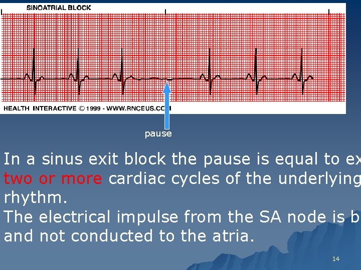 pause In a sinus exit block the pause is equal to ex two or