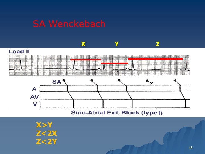 SA Wenckebach X X>Y Z<2 X Z<2 Y Y Z 18 