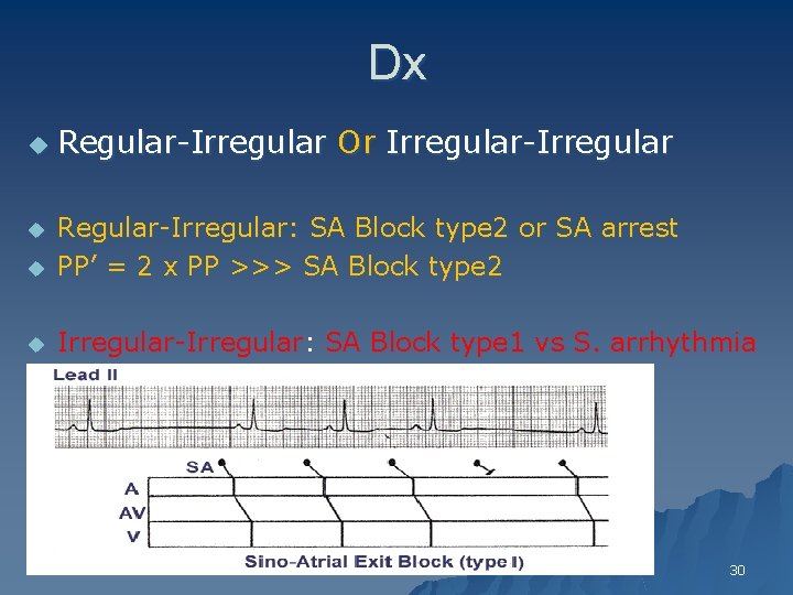 Dx u Regular-Irregular Or Irregular-Irregular u Regular-Irregular: SA Block type 2 or SA arrest