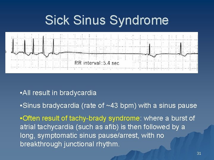 Sick Sinus Syndrome • All result in bradycardia • Sinus bradycardia (rate of ~43