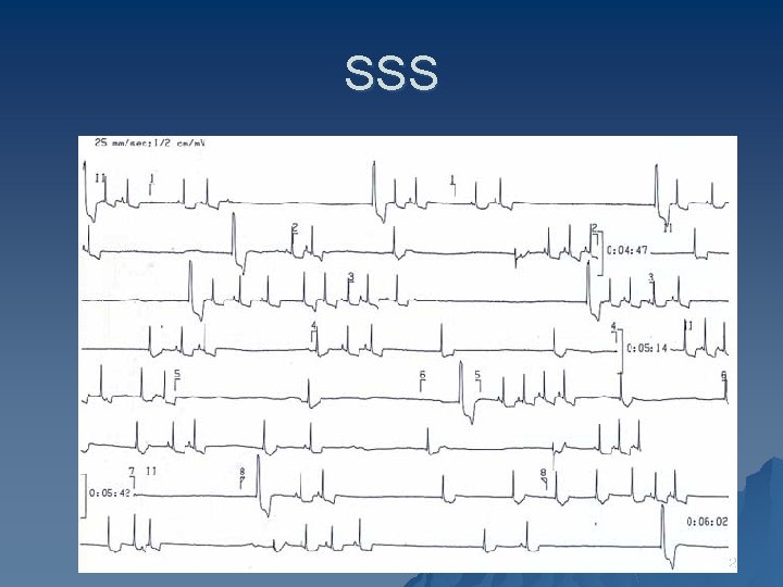 SSS 32 