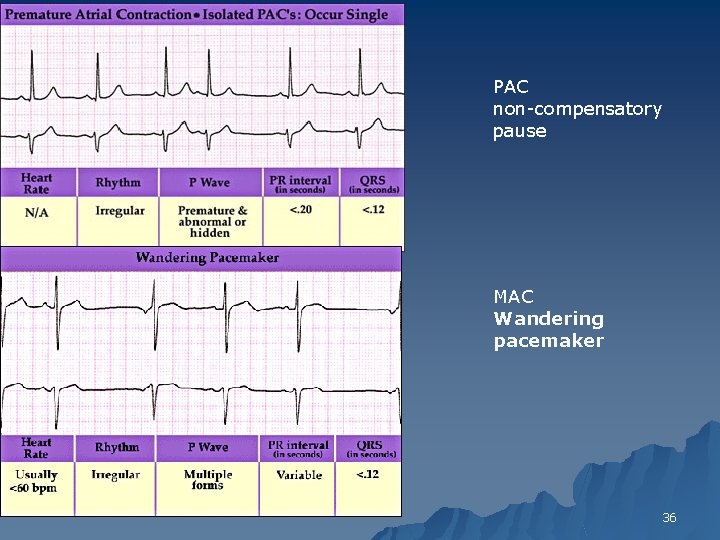 PAC non-compensatory pause MAC Wandering pacemaker 36 