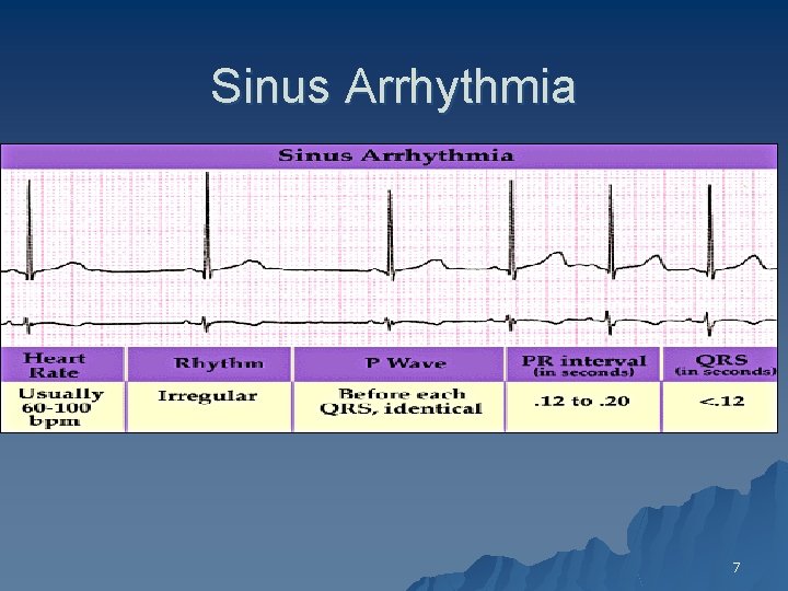 Sinus Arrhythmia 7 