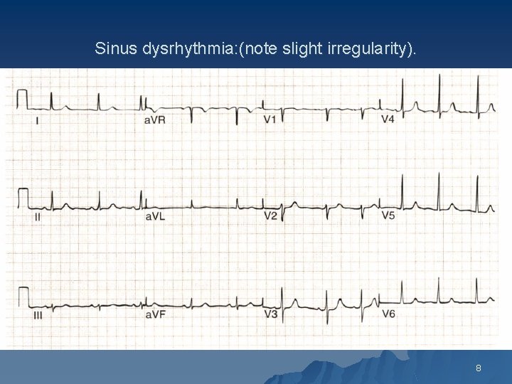 Sinus dysrhythmia: (note slight irregularity). 8 